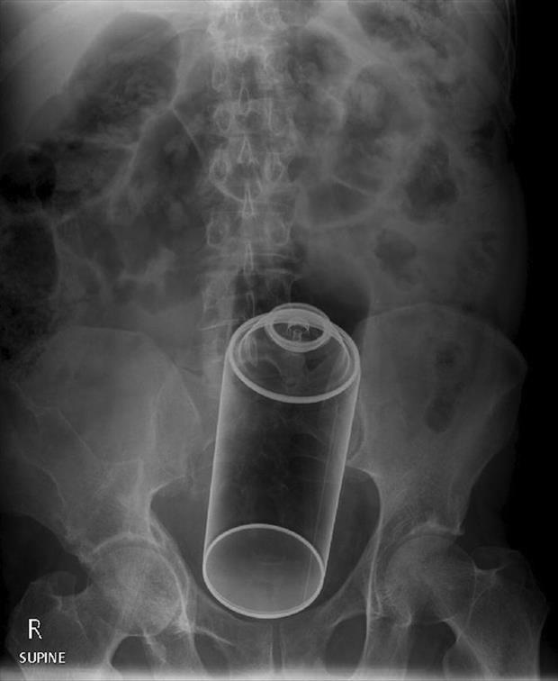 x rays up butt (4)