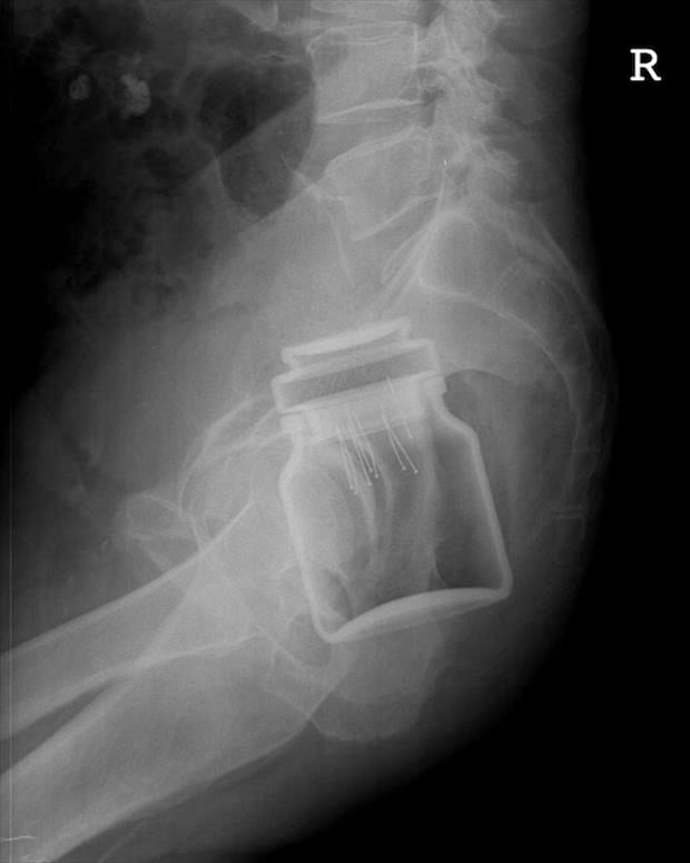 x rays up butt (5)