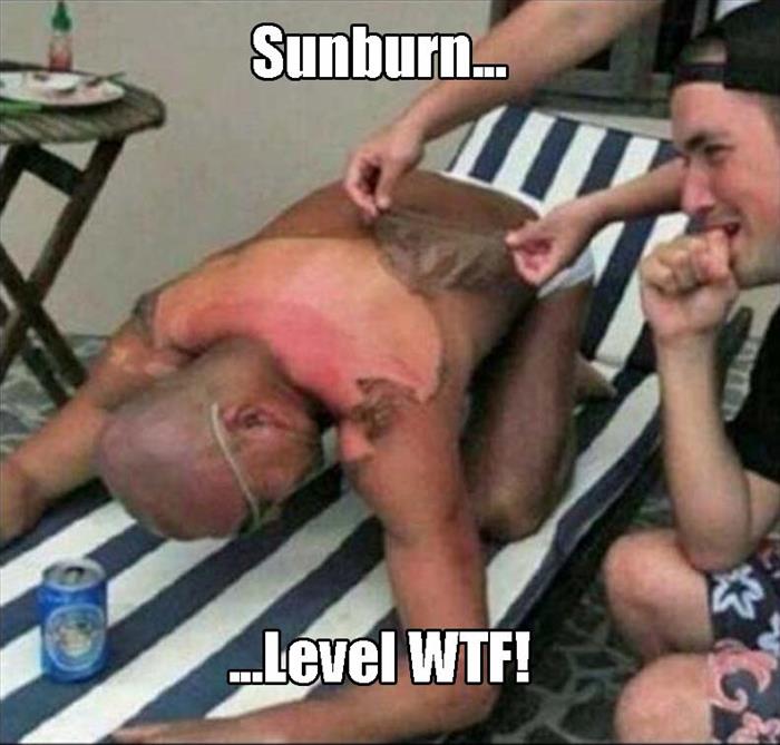 sunburn